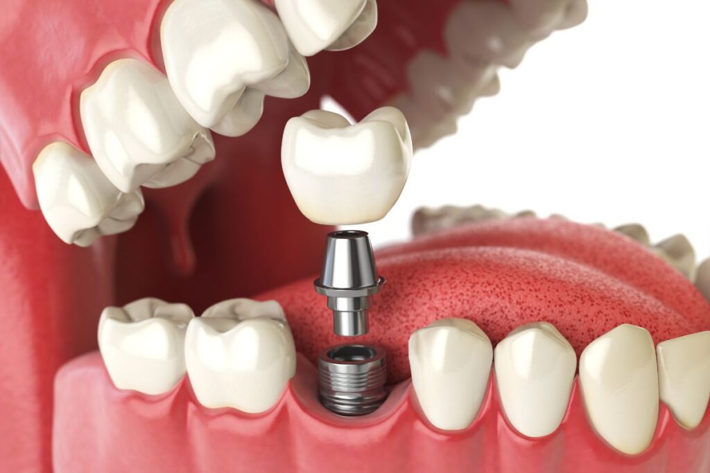 co zamiast implantu